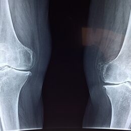 Bild zeigt Röntgenaufnahme von Knie